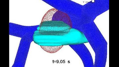 Computational Modelling of liver tumor ablation by high intensity focused ultrasound (HIFU)