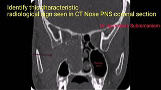 ENT Image based question 86