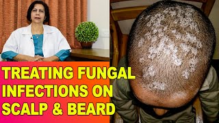 Fungal/Fangal Infections, Itching in Head/Scalp & Beard - Treatment || Dr Vijaylaxmi Singh