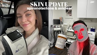 7 month spironolactone (for acne) skin update &amp; starting aviclear