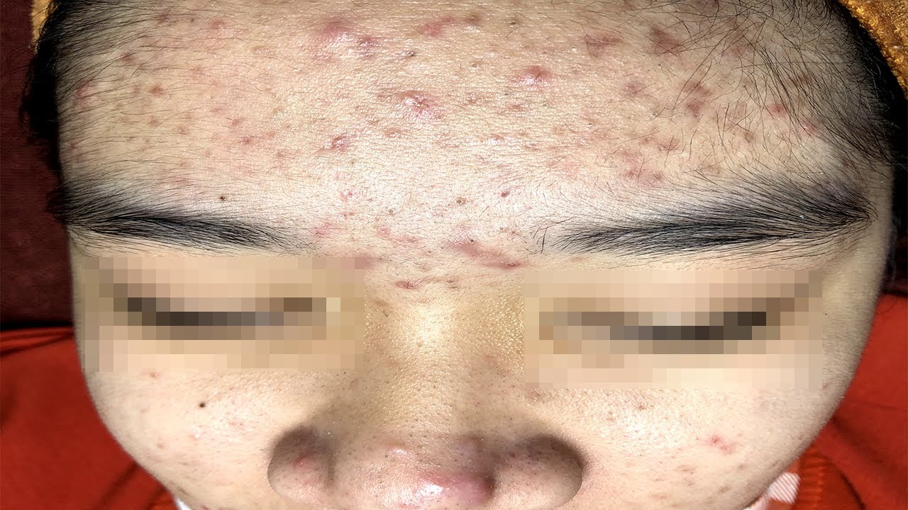 How To Remove Acne Easily On Facial | Cách Loại Bỏ Mụn Dể Dàng Trên Da Mặt - SacDepSpa#31