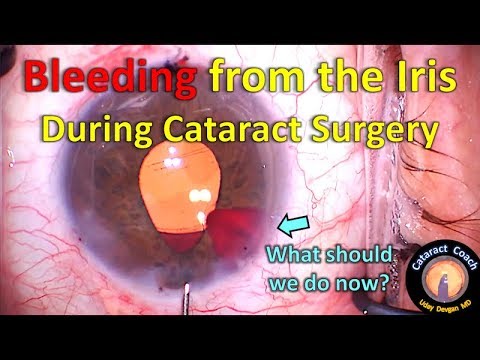 Effective Treatment of Iris Bleeding during Cataract Surgery