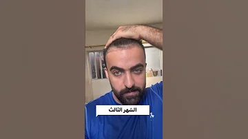 زراعة الشعر من اول يوم لاخر يوم 