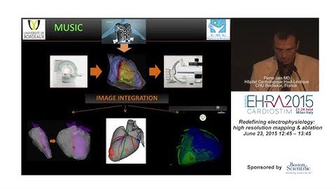 High resolution mapping in VT: feasibility and clinical meaningfulness