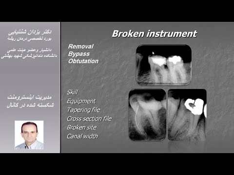 تصویری: نحوه درمان دندان شکسته (همراه با تصاویر)