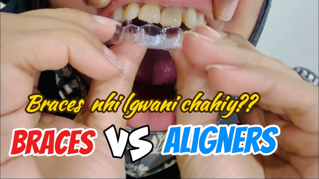 Teeth gap best treatment ? 🇵🇰😃 Aligners vs metal Braces cost of