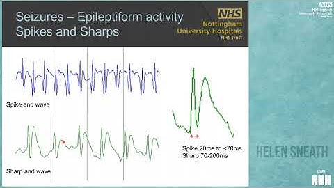 Neurophysiological Monitoring on ICU, brain waves, trends and artefacts