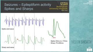 Neurophysiological Monitoring on ICU, brain waves, trends and artefacts