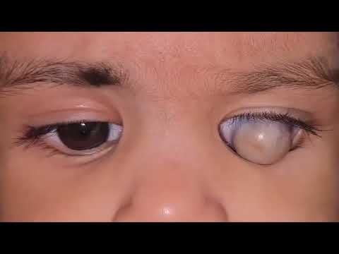Queratomalacia