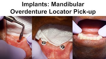 2. Implants: Mandibular Overdenture Locator Pick-up