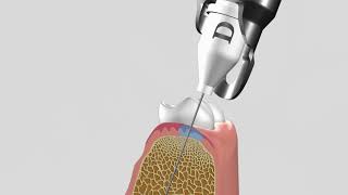 Intraosseous Anesthesia - Full Protocol - English Voiceover