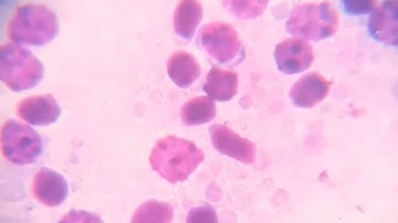 Dive into the Microscopic Universe of Diffuse Large B Cell Lymphoma!