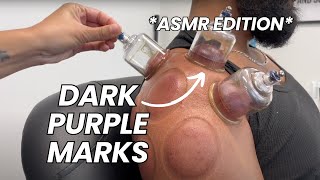 ASMR Cupping for Shoulder Pain