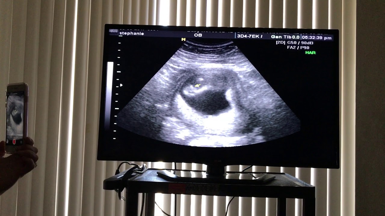 Baby gender reveal 14 weeks and 3 days YouTube