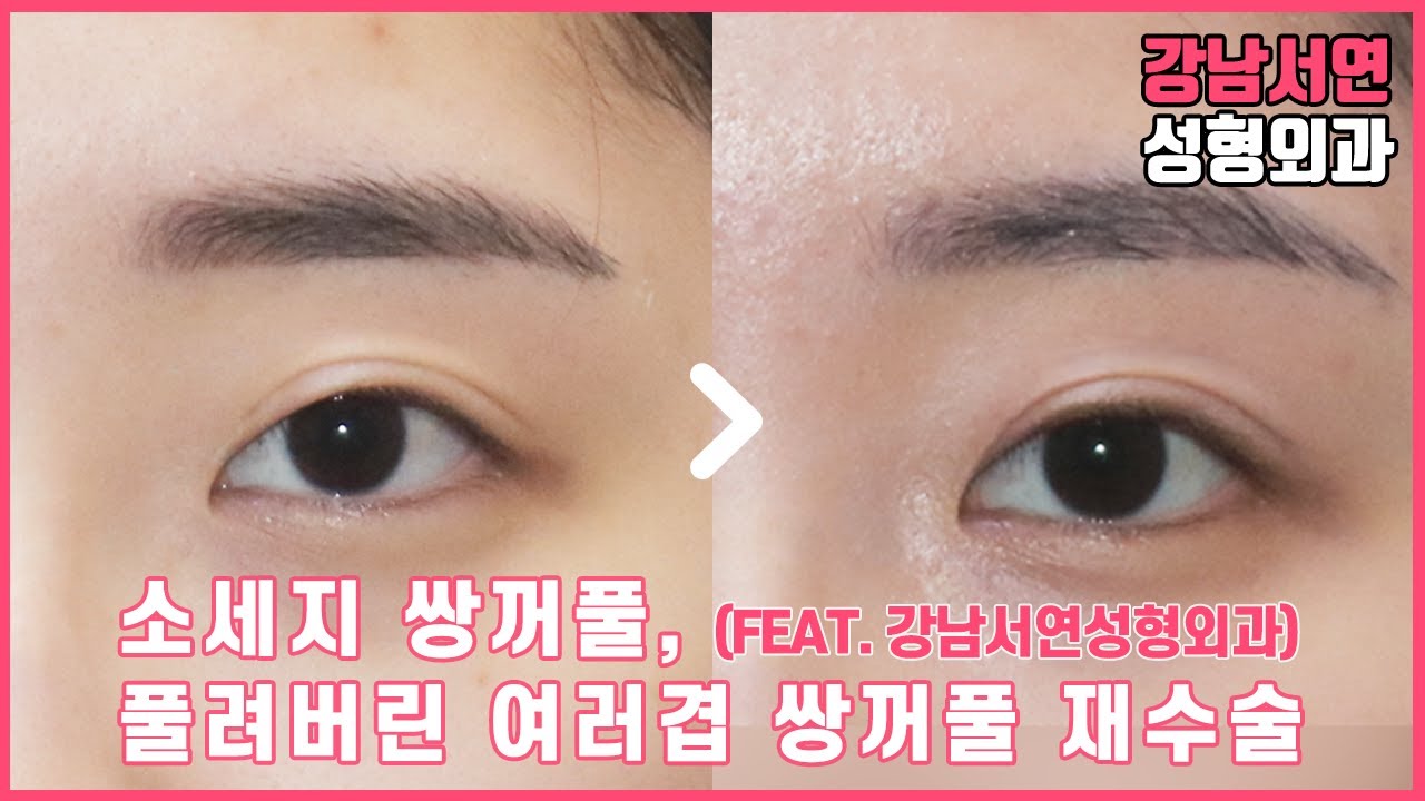 [Ганнам Соён Гоо Сайхны Мэс Заслын Эмнэлэг] Нүдний мэс заслын өмнө ба хойно – Давхар зовхины засах мэс засал, Хиам шиг хөөсөн, олон давхаргатай болсон давхар зовхийг сайжруулах