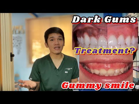 GUMMY SMILE, DARK GUMS and UNEVEN TEETH: Treaments (Gingivectomy, Gum Bleaching and Enameloplasty)