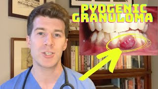 How to recognise and treat a Pyogenic Granuloma | Doctor O'Donovan