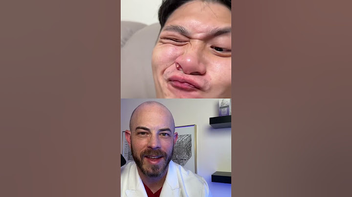 Derm reacts to using facial contortion to pop juicy pimple! #dermreacts #doctorreacts #pimplepop