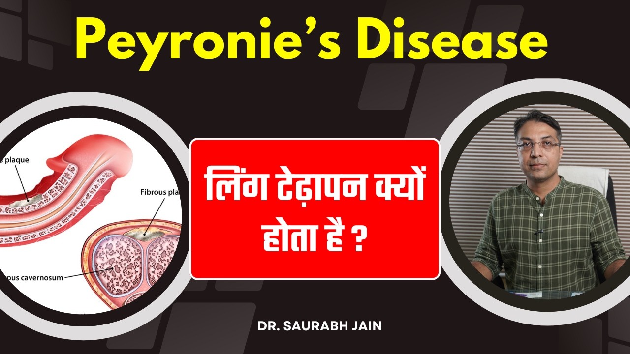 Peyronies Disease Causes and Stages Explained | लिंग टेढ़ापन क्यों होता ...