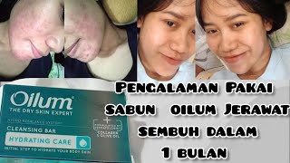 JERAWAT SEMBUH ? pakai sabun OILUM hydrating care 1 bulan jerawat hilang.