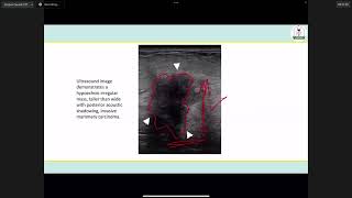 Lec. 27 | Surgery Major [ Group C ] ( Dr. Ghaith ) | Breast Cancer