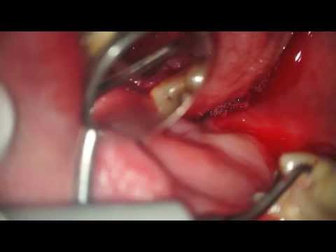 Video: Tandcyste (aan De Wortel) - Oorzaken En Symptomen, Verwijdering Van De Cyste Aan De Wortel Van De Tand (operatie)