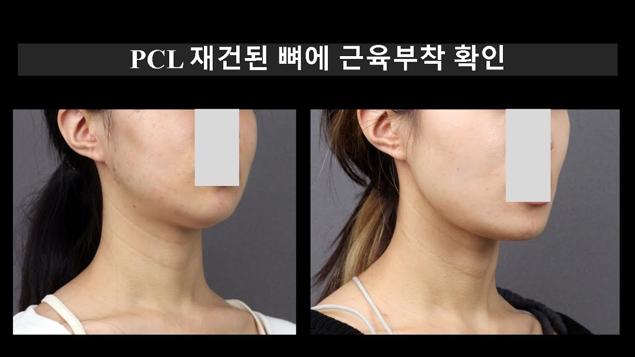 Подтверждение прикрепления мышцы к кости после реконструкции задней крестообразной связки.