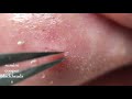 鼻角栓116.2nose blackheads（Larger version）★Tweezers only★