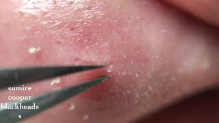 鼻角栓116.2nose blackheads（Larger version）★Tweezers only★
