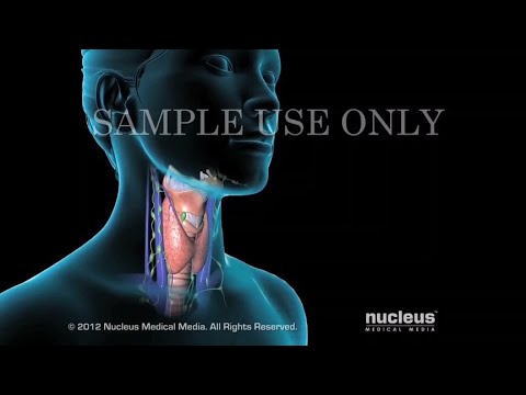 冯提莫的甲状腺癌严重吗，甲状腺癌的基本知识，3D演示。。