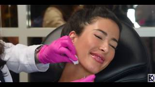 Jawline Filler Using Radiesse with @KyleeCampbell