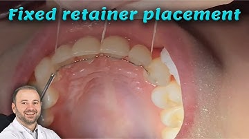 Fixed retainer placing on in 5 minutes only!! retainer wire bonding, fix retainer after braces off