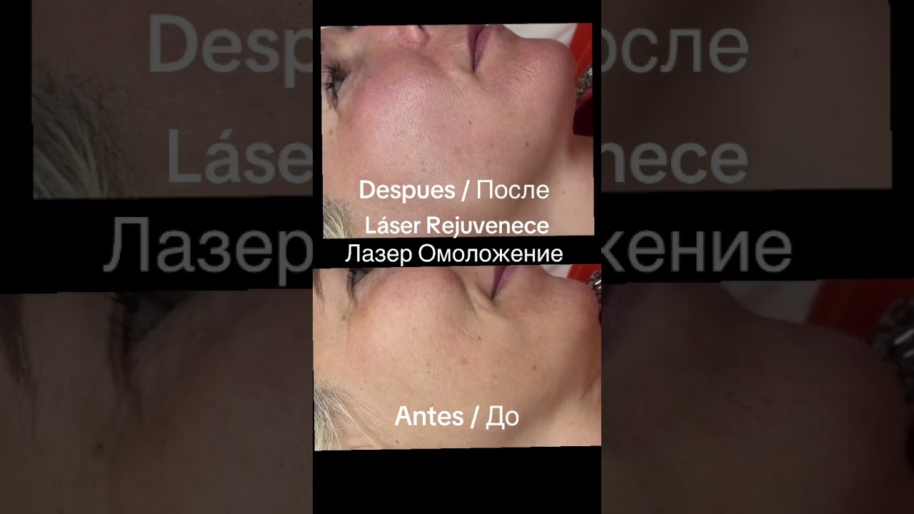 Láser Rejuvenecimiento de la piel /Лазер омоложения кожи