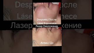 Láser Rejuvenecimiento de la piel /Лазер омоложения кожи