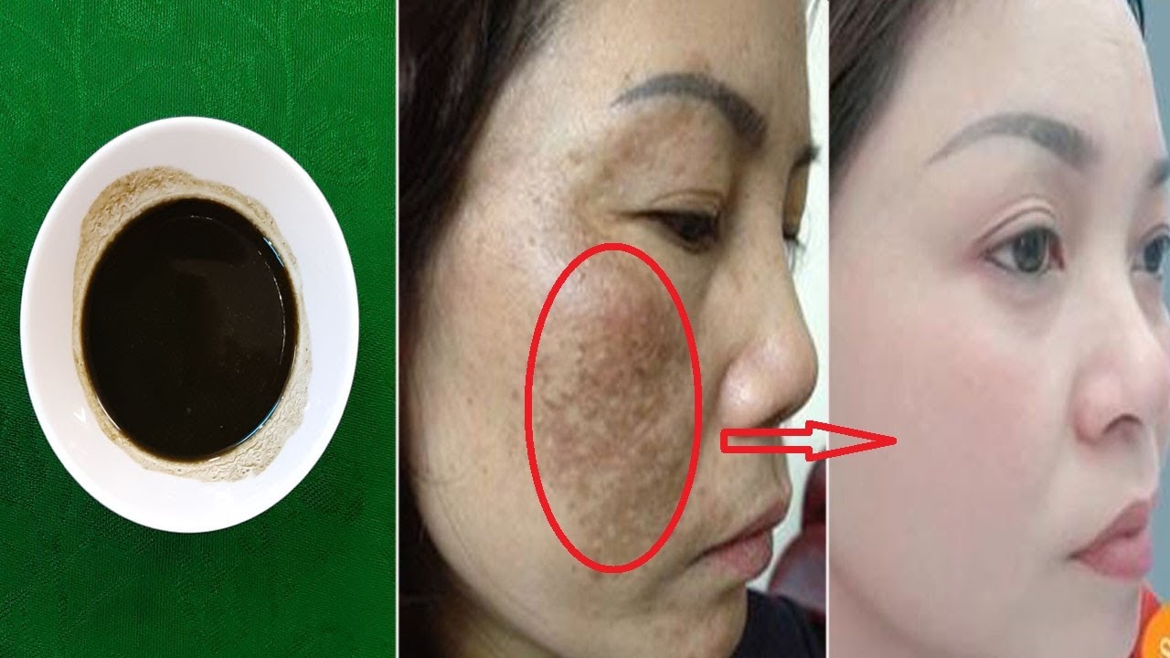 Get Rid Of Pigmentation, Melasma and Freckles On Your Face Fast At Home