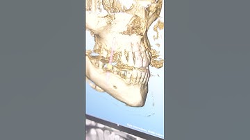 Dental Dictionary 📖🦷: CBCT (Cone Beam Computed Tomography) #expressdentallab