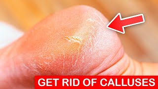 How to Get Rid of Calluses at Home #shorts