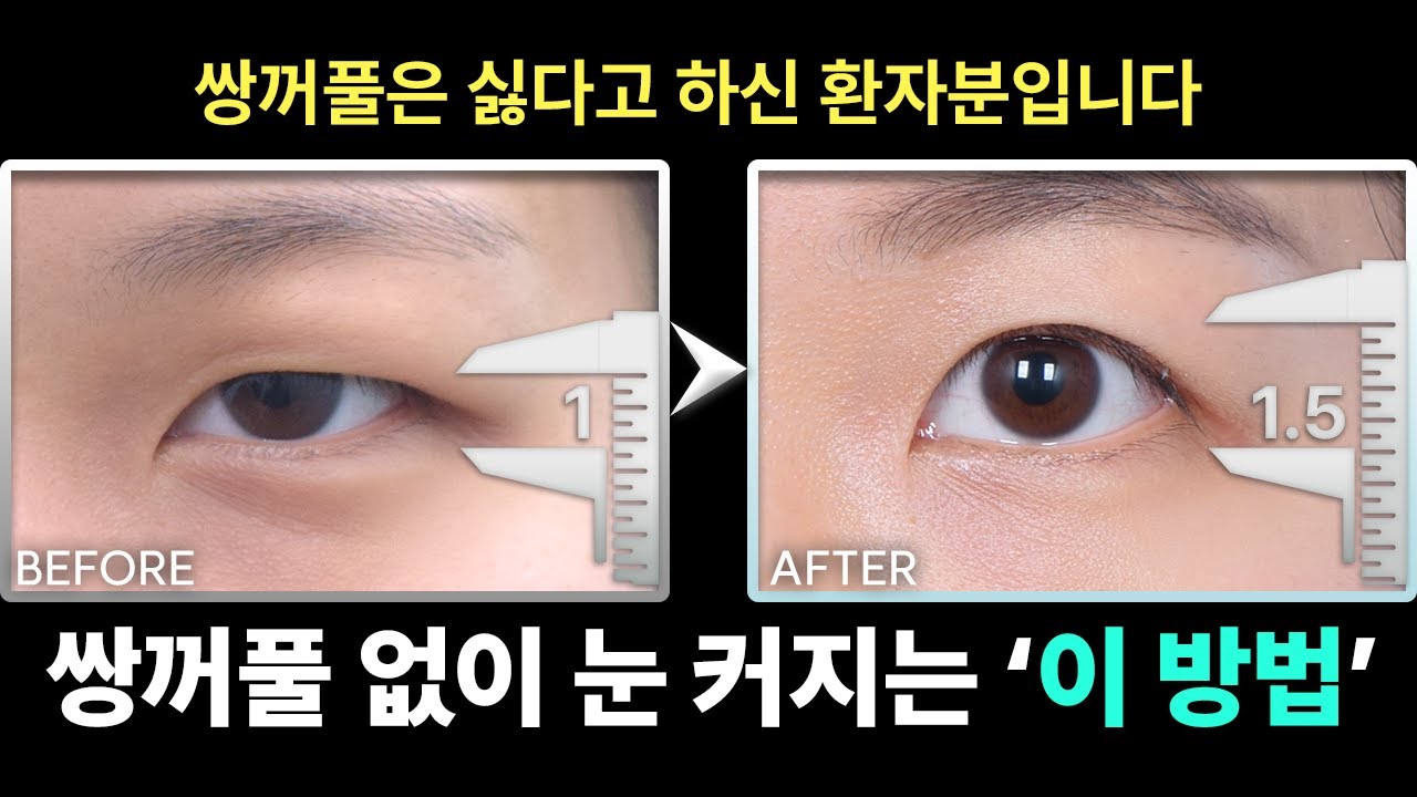 [실제성형리뷰] 무쌍으로 눈 크기 1.5배 만들어 드렸습니다.