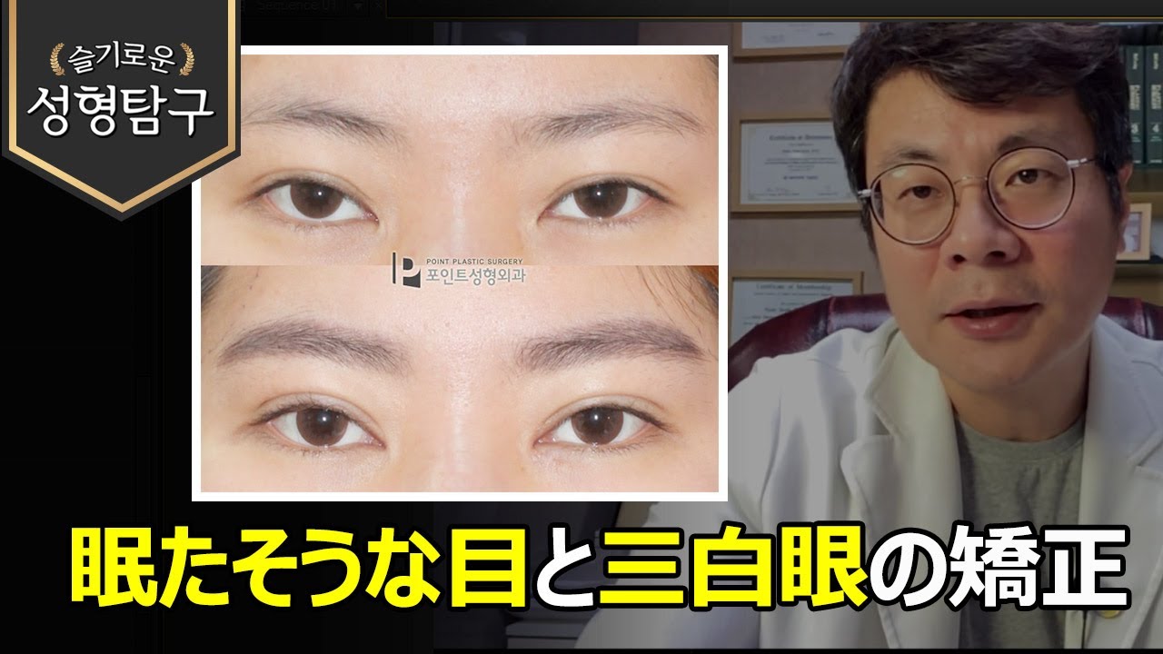 左右非対称と三百眼で眠たそうな目の改善症例 Youtube 左右非対称と三百眼で眠たそうな目の改善症例 Youtube