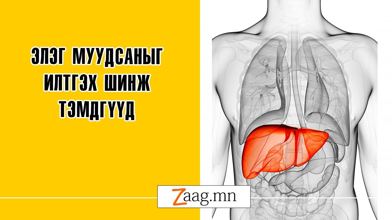 Элэг муудсаныг илтгэх шинж тэмдгүүд