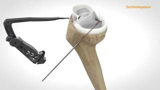 Meniscal Root Repair Two-Tunnel Technique With Firstpass Mini 14926-1 V4