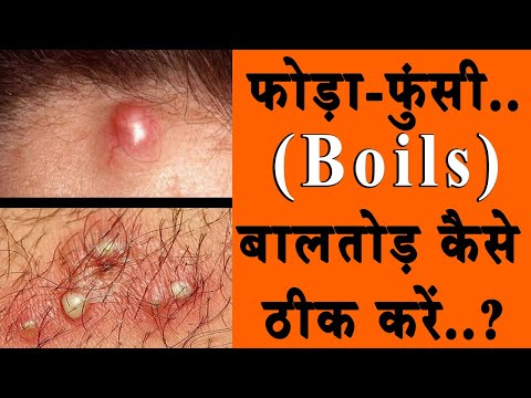 फोड़ा-फुंसी..बालतोड़ सिर्फ 1 बार में ठीक करें..जानिए कैसे..?/Boils Best Treatment 100% Effective