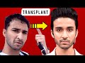 RAGHAV JUYAL|TRANSPLANT|RECEDING|Hair|Line|HairFall|MINOXIDIL|FINASTERIDE|results|hindi|Celebrity