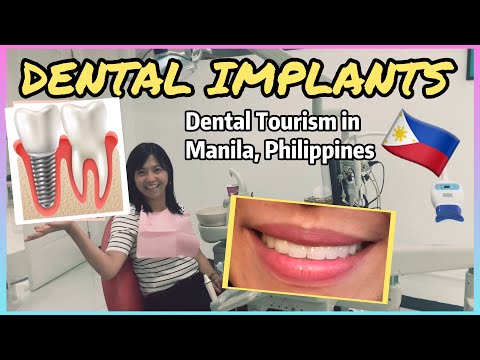 Video: Nakakuha si Valentina ng mga implant sa ngipin