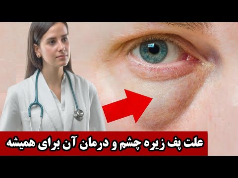 پف زیر چشم چه زمانی اتفاق می افتد و چگونه سریع درمان میشود