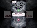 Why “Baad Mein” isn’t always an option for fertility | Zemya IVF