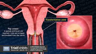 Uterine Anatomy, PAP Smear and Cervical Cancer