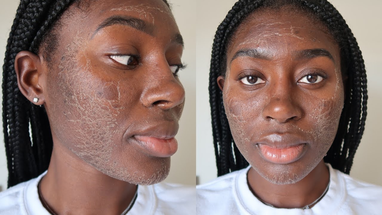 ZENA ALGAE PEEL REVIEW RESULTS BEFORE AND AFTER YouTube
