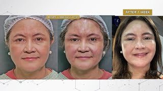 Age-Defying Transformation: Reverse Cog Thread Lift for Facial Rejuvenation in a Mature Woman