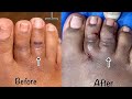 MINIMALLY INVASIVE TOE SHORTENING REVISION SURGERY - (BEFORE AND AFTER)